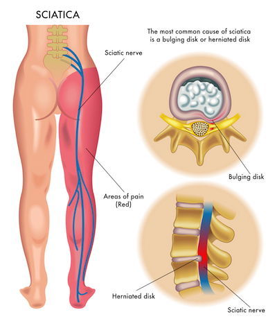 Low Back and Leg Pain is Lumbar Radiculopathy