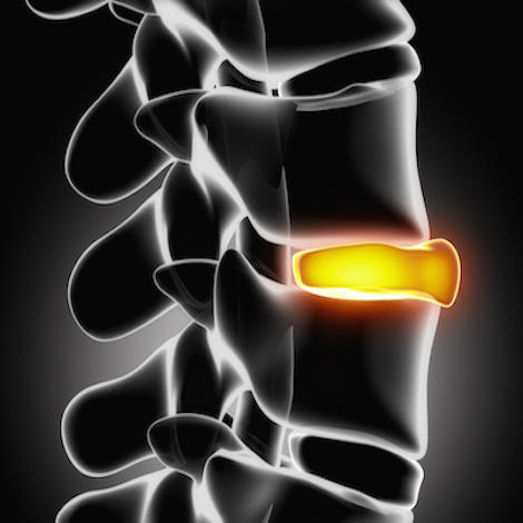 cracked disk xray lumbar spine